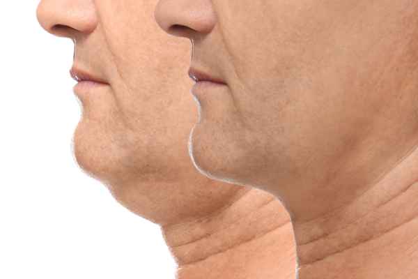 HIFU - Breakthrough in Anti - ageing 2 hifu results Livingston