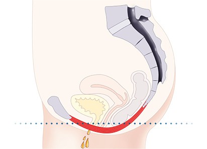 Pelvic-Floor Muscle Repair 5 Pelvic floor muscles Livingston