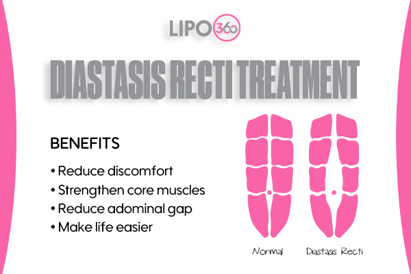 Revolutionising Muscle Repair: The Power of LIPO360 Body Sculpt Post-Injury 5 diastasis recti treatment Livingston