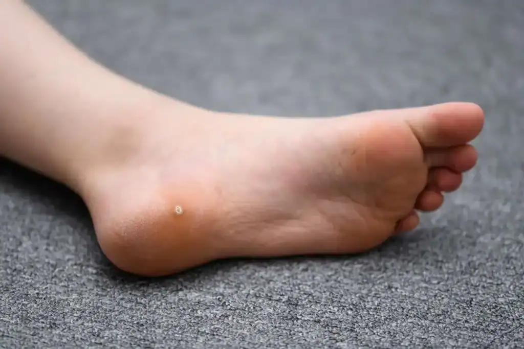 Cryotherapy For Warts And Also Verrucas 2 Image of verruca on the bottom of the foot that able to be treated with Cryotherapy Livingston