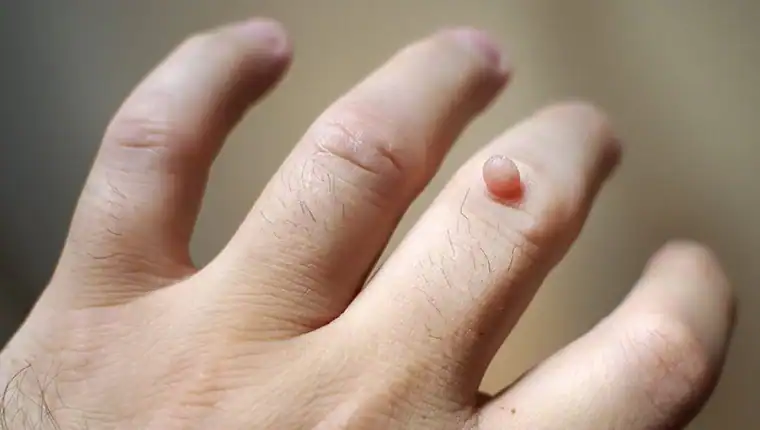 Image of blemish that Cryotherapy Livingston can remove with Lipo 360.