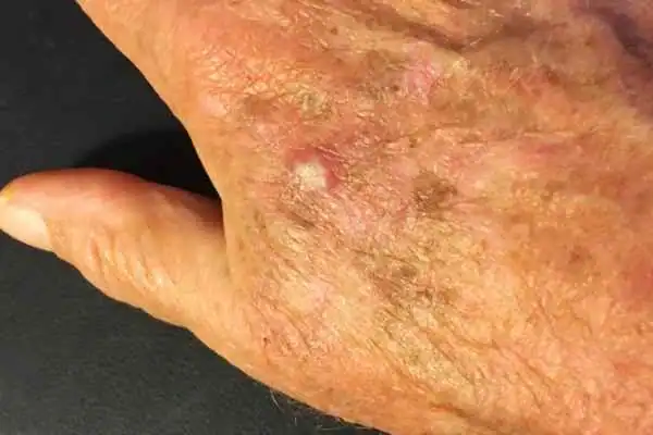 Image of Actinic keratoses Livingston on a person hand