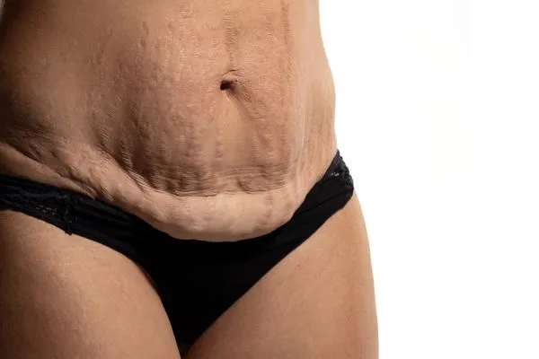 The science behind skin tightening Livingston picture of a woman's sagging skin on the stomach